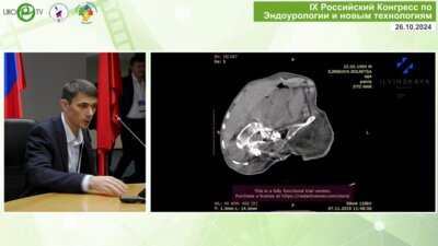 Епишов В.А. - Перкутанная нефролитотомия у пациента со спинальной мышечной атрофией