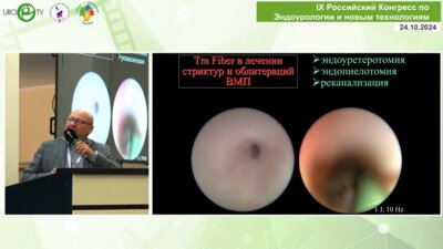 Мартов А.Г. - ТВЛ в лечении других заболеваний ВМП (папиллярный рак, стриктуры, синусные кисты и др.)