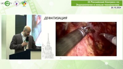 Камалов Д.М. - Робот-ассистированная простатэктомия у пациентов с выраженной средней долей