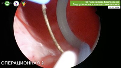 Севрюков Ф.А. - Биполярная энуклеация простаты (TUEB)