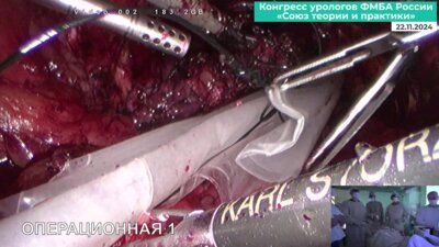 Биктимиров Р.Г. - Лапароскопичесская простатэктомия