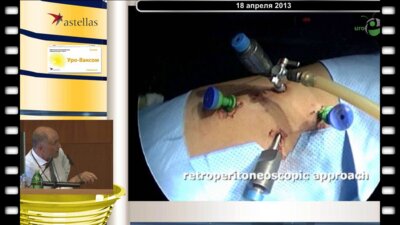 Valla J-S - Видеохирургические реконструктивно-пластические операции в детской урологии(Детская больница Lenval, Ницца, Франция) 