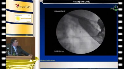 Тегюл С. - Малоинвазивные методы лечения мочекаменной болезни у детей (Университет Hacettepe, Анкара, Турция)