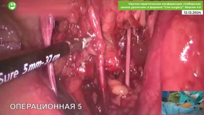 Волокитин Е.В. - Лапароскопическая радикальная простатэктомия