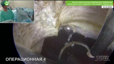 Неймарк Б.А. - Трансуретральная резекция предстательной железы