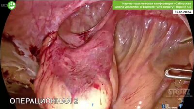 Холтобин Д.П. - Лапароскопическое ушивание пузырно-прямокишечного свища