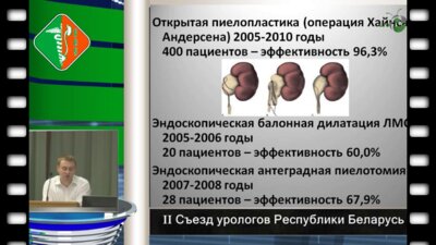 Дубров В.И. - Результаты применения лапароскопической пиелопластики при гидронефрозе у детей.  