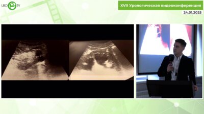 Лысёнок А.Ю. - Лапароскопический уретеронеоцистоанастамоз неполно удвоенной почки - клинический случай