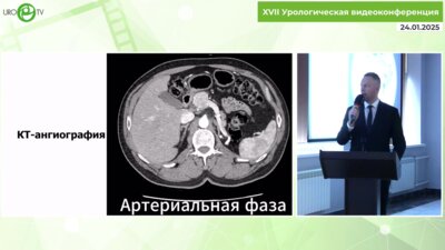 Милошевский П.В. - Лапароскопическая резекция опухоли подковообразной почки - всегда с приключениями
