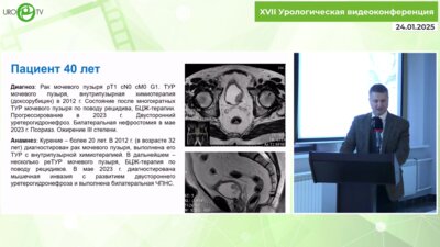 Монаков Д.М. - Робот-ассистированная цистпростатвезикулэктомия с интракорпоральным формированием необладдера