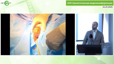 Пелих К.И. - Сосудистая мальформация клитора