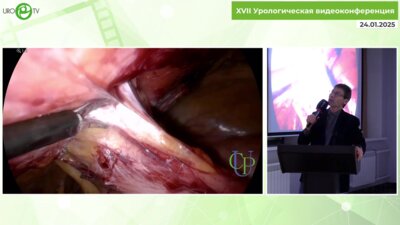 Перлин Д.В. - Лапароскопическая повторная реконструкция уретероилеостомы
