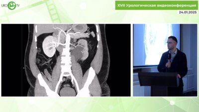 Слусаренко Р.И. - Опыт молодого бойца - ранение наружной подвздошной артерии при лапароскопической нефрэктомии