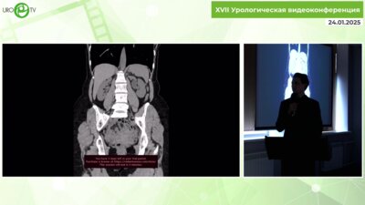 Степанченко В.С. - Лапароскопическая пластика ЛМС с каликолитоэкстракцией фиброскопом