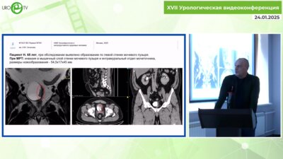 Суханов Р.Б. - Технические особенности en-bloc опухоли мочевого пузыря, расположенной в области устья