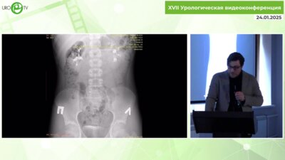 Хватынец Н.А. - Вазопексия у ребенка 15 лет с рецидивирующими почечными коликами