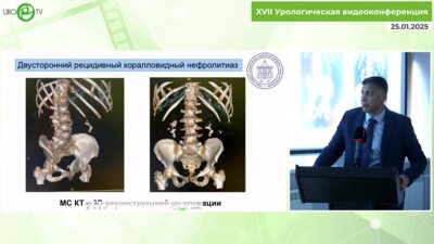 Ал-Аттар Т.Х. - Лапароскопическая нефролитотомия с каликоилеоцистоанастомозом