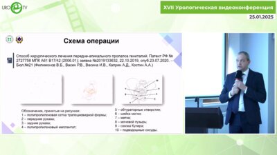 Васин Р.В. - Лапароскопическая пектопексия в сочетании с влагалищным этапом установки сетчатого имплантата при пролапсе гениталий
