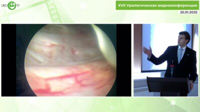 Волков С.Н. - Лапароскопическая радикальная простатэктомия+уретероцистонеоанастамоз+двусторонняя пластика паховых грыж