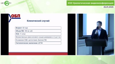 Лугинов Б.А. - Симультанная экстраперитонеоскопическая аденомэктомия с удалением крупных камей МП
