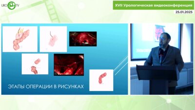 Оччархаджиев С.Б. - Конверсия континентной кишечной уродеривации