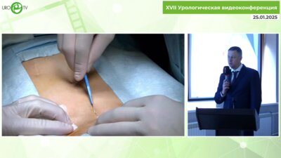 Пинчук И.С. - Коррекция недержания мочи у пациентов с континентной стомой