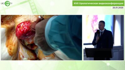 Пинчук И.С. - Коррекция тотального пролапса у женщины