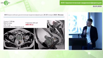 Собенин В.Г. -   Лапароскопическая радикальная простатэктомия Monster Size Prostate