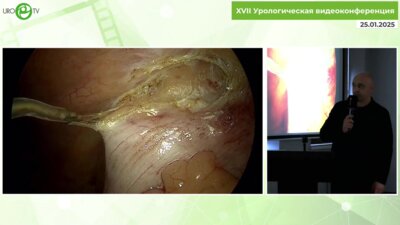 Шкодкин С.В. - Рецидивная аппендэктомия