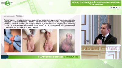 Хуснуллин И.Н. - Лечение дистальных форм гипоспадии с применением аутологичной плазмы обогащенной тромбоцитами