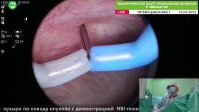 Орлов И.Н.  - Olympus Plasma и биполярная ТУР мочевого пузыря по поводу опухоли с демонстрацией NBI технологии