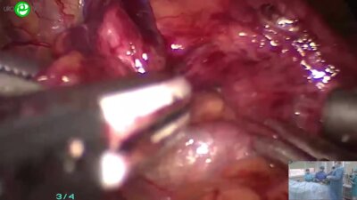 Безруков Е.А. - Лапароскопическая простатэктомия с тазовой лимфаденэктомией