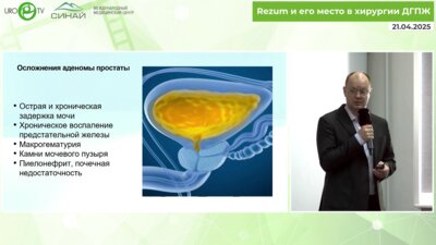 Степанов В.С. - Инновационный метод лечения аденомы простаты REZUM. 90 пациентов