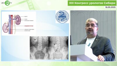 Феофилов И.В. - Новый способ лапароскопической нефропексии