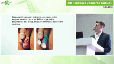 Шпак П.В. - Первый опыт люмбоскопического доступа в лечении варикоцеле