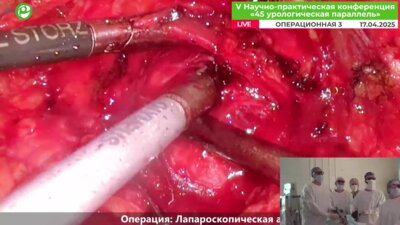 Невский А.А. - Лапароскопическая аденомэктомия