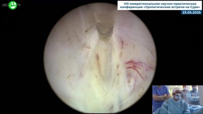 Гоняев А.Р. - Лазерная гольмиевая энуклеация предстательной железы (лазер MuitiPulse Ho)