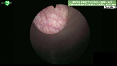 Суханов Р.Б. - Лазерная энуклеация гиперплазии простаты total en bloc