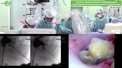 Али С.Х., Лобанов М.В. - Миниперкутанная нефролитотрипсия с пункцией под визуальным контролем