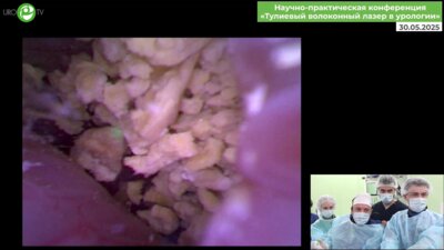 Малхасян В.А. - Гибкая ретроградная интраренальная хирургия