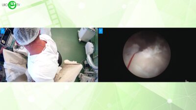 Лавинский Р.В. - Биполярная энуклеация гиперплазии простаты Би-ТУЭП