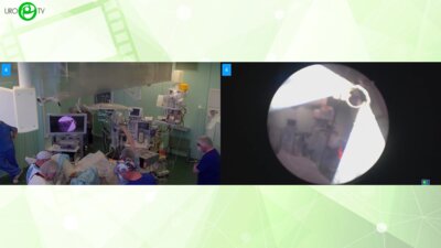 Мартов А.Г. - Биполярная резекция опухоли мочевого пузыря Power LED Saphira PDD