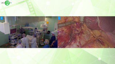 Рева С.А. - Лапароскопическая резекция почки Rubina