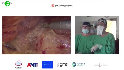 Кочкин А.Д. - Лапароскопическая секционная нефролитотомия с тепловой ишемией