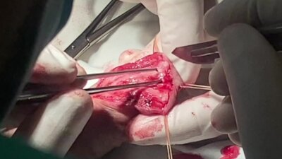 Т-образная пластика ладьевидной ямки уретры