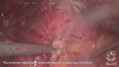 Лапароскопическая чрезпузырная аденомэктомия