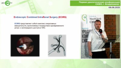 Тохтиев З.Т. - Эндоскопическая комбинированная интраренальная хирургия