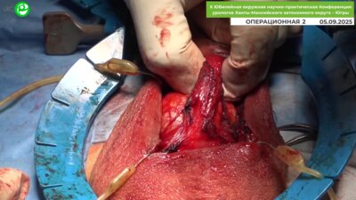 Сайидов Т.Н. - Фаллопротезирование однокомпонентным протезом