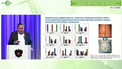 Грицкевич А.А. - Радикальная цистэктомия с использованием роботической техники. Опыт НМИЦ хирургии им. А.В. Вишневского