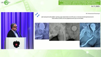 Живов А.В. - Анастомотическая уретропластика. Выбор доступа